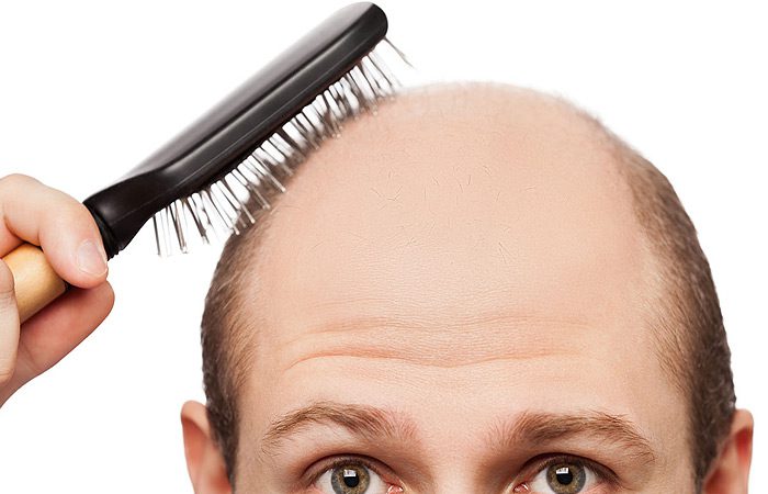 درمان ریزش مو با از کار انداختن یک ژن در بدن