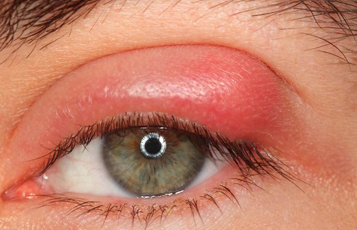 علائم و مراحل درمان شالازیون چشم