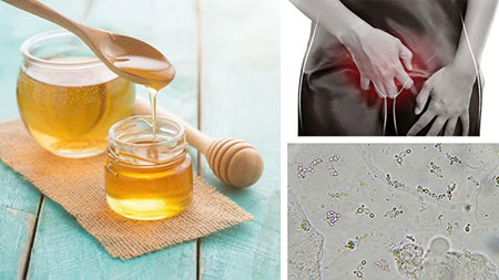 درمان عفونت واژن با عسل