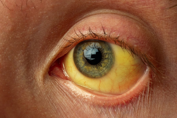 زردی چشم کی خطرناک می شود؟
