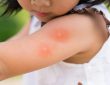 درمان و پیشگیری از نیش زدن پشه در کودکان
