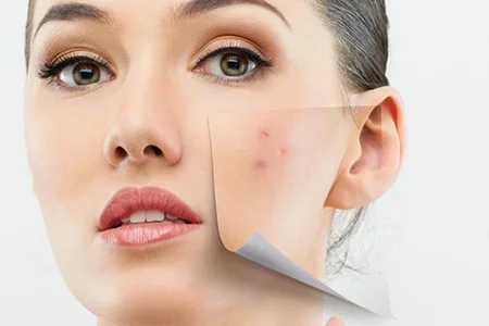چگونه پوست چرب و جوش دار را پاکسازی کنیم 1