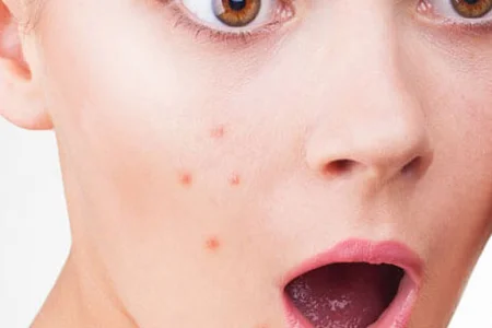 دلایل جوش زدن صورت قبل از مهمانی های مهم 2