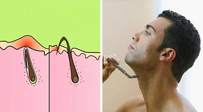 مو‌های زیر پوستی چرا به وجود می‌آیند؟