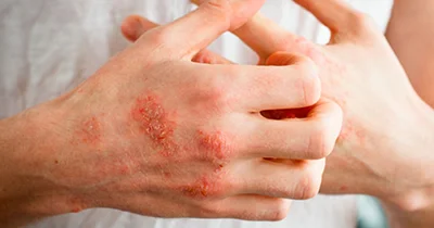 با اگزمای زمستانی چه کنیم؟