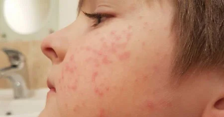فولیکولیت (التهاب یا عفونت فولیکول مو)؛ درمان و پیشگیری از آن