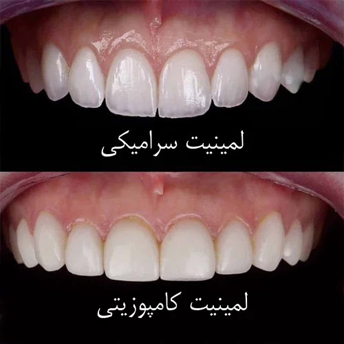 مقایسه لمینت سرامیکی با کامپوزیت